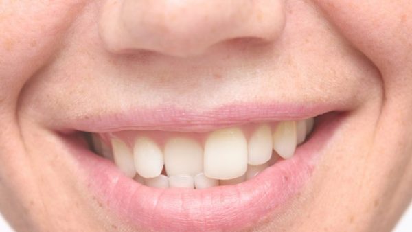 ¿Qué es la maloclusión dental?