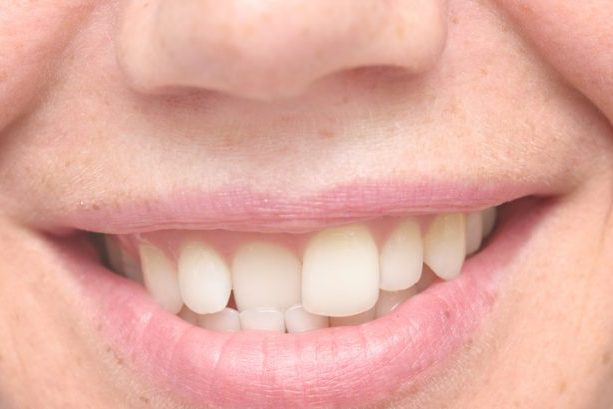 ¿Qué es la maloclusión dental?