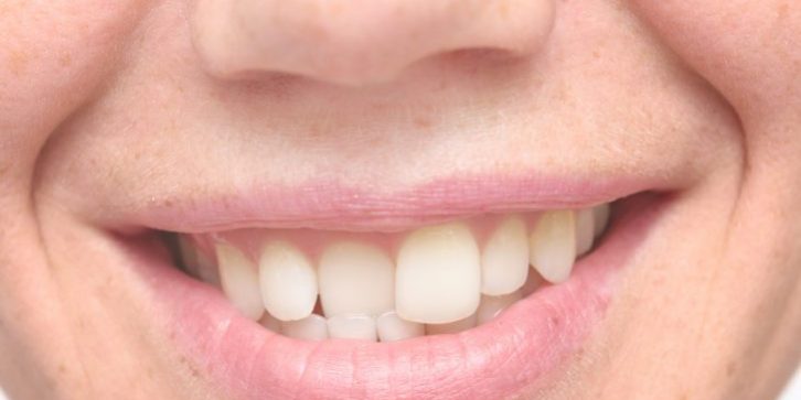 ¿Qué es la maloclusión dental?