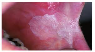 leucoplasia oral