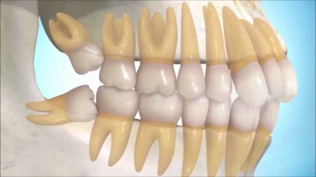 Muelas del juicio retenidas - Clínica dental en Getxo, BP