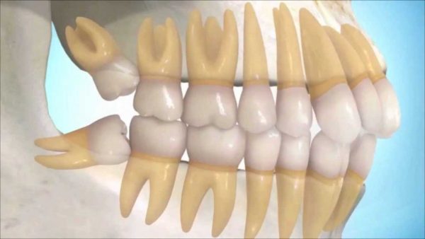 Muelas del juicio retenidas - Clínica dental en Getxo, BP