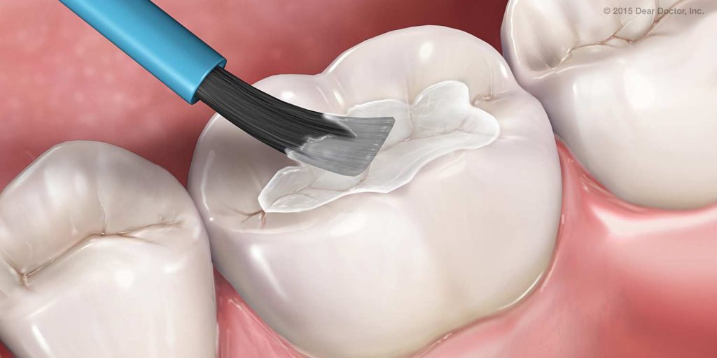 selladores dentales clinica dental dientes blancos