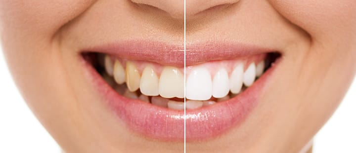 blanqueamiento dental clinica dientes blancos