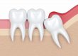 Muela del juicio retenida - Belén Pérez, clínica dental Getxo
