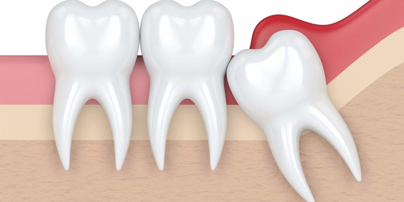Muela del juicio retenida - Belén Pérez, clínica dental Getxo