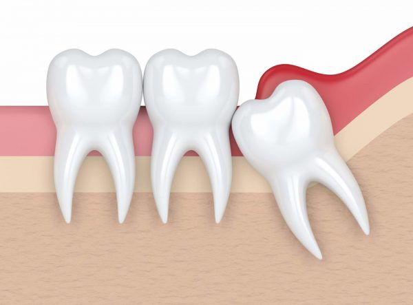 Muela del juicio retenida - Belén Pérez, clínica dental Getxo