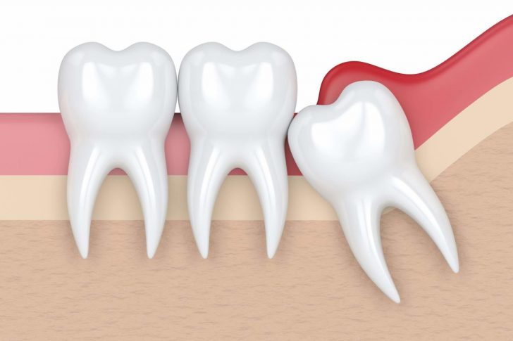 Muela del juicio retenida - Belén Pérez, clínica dental Getxo