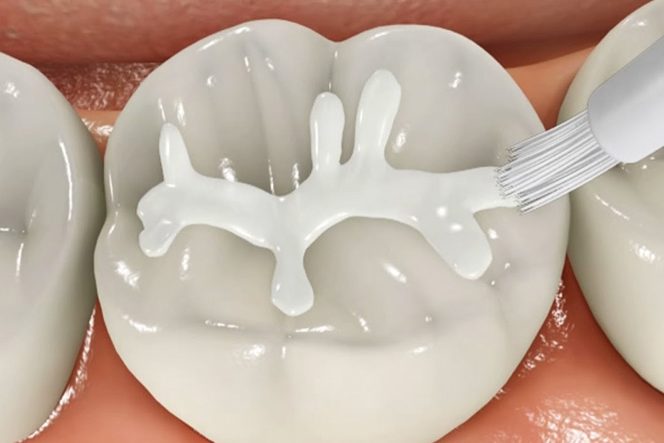 selladores dentales