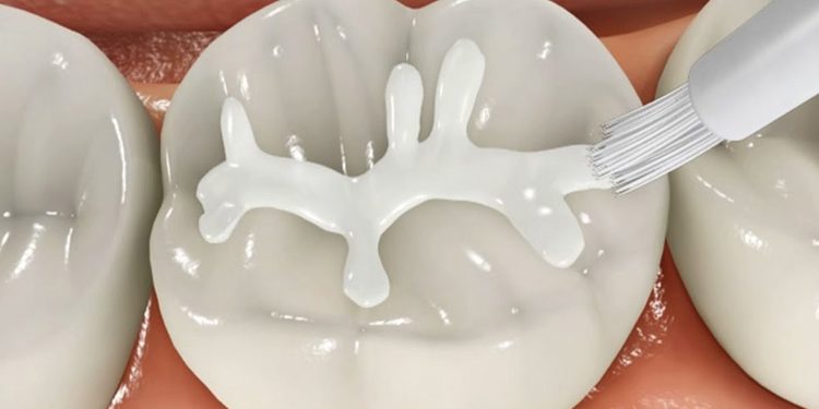 selladores dentales