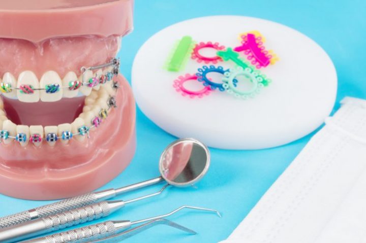 tipos de brackets y de ortodoncia