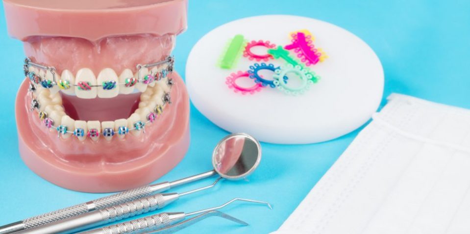 tipos de brackets y de ortodoncia