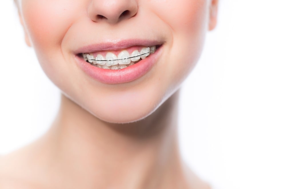 La ortodoncia convencional estética es uno de los tipos de brackets que usamos en Belén Pérez Dental