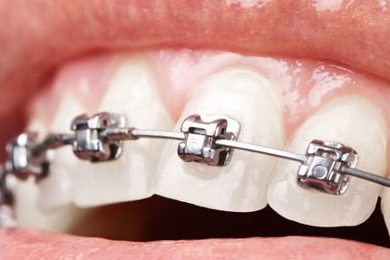 brackets qué alimentos son recomendables - Clínica dental en Getxo Belén Pérez
