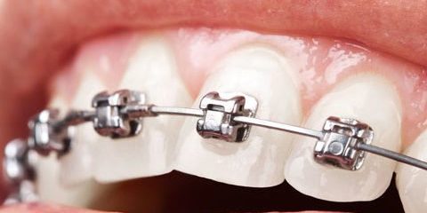 brackets qué alimentos son recomendables - Clínica dental en Getxo Belén Pérez