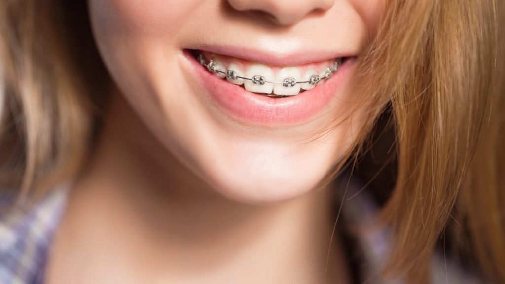 La ortodoncia convencional es uno de los tipos de brackets que usamos en Belén Pérez Dental