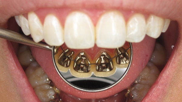 La ortodoncia lingual es uno de los tipos de brackets que usamos en Belén Pérez Dental