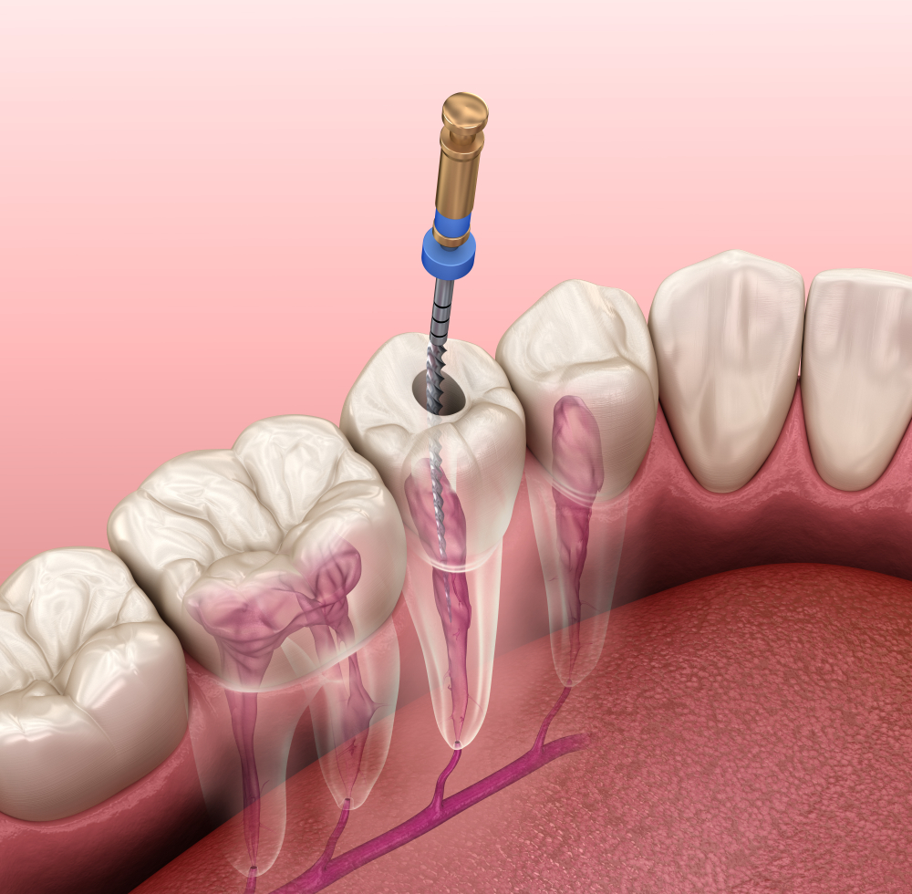 Endodoncia en Getxo
