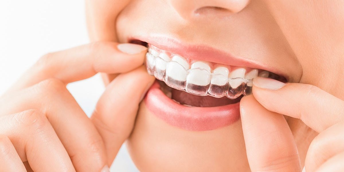 invisalign