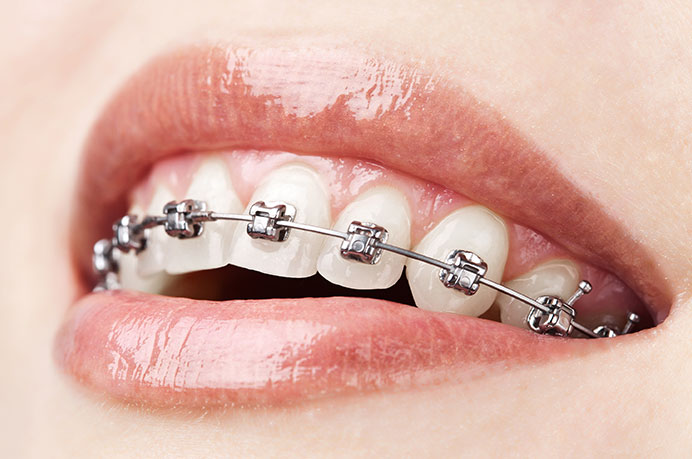 brackets