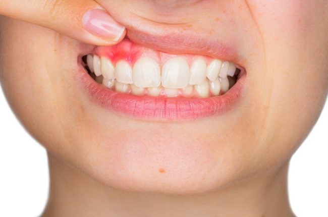 Absceso dental o flemón - Belén Pérez clínica dental en Getxo