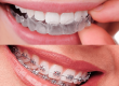 Ortodoncia invisible y brackets