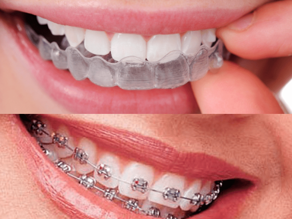 Ortodoncia invisible y brackets