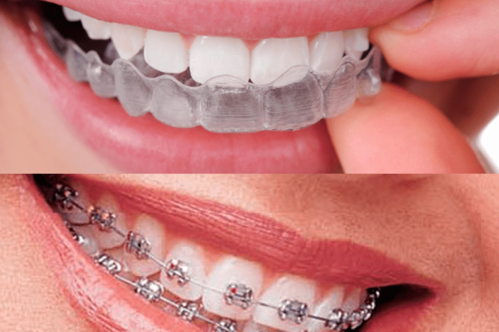 Ortodoncia invisible y brackets