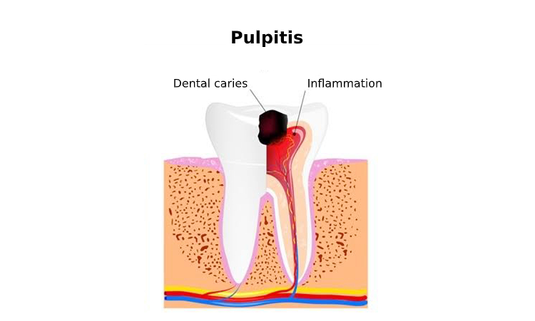pulpitis