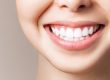 Como hacer un blanqueamiento dental casero - Clínica dental Belén Pérez