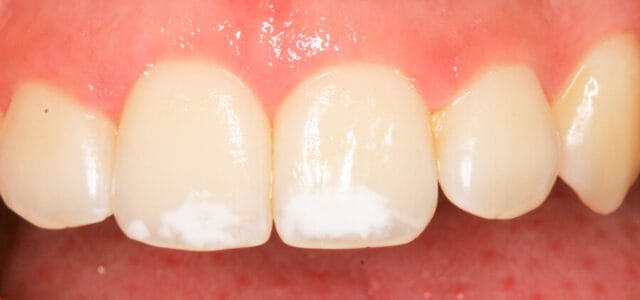 hipoplasia del esmalte