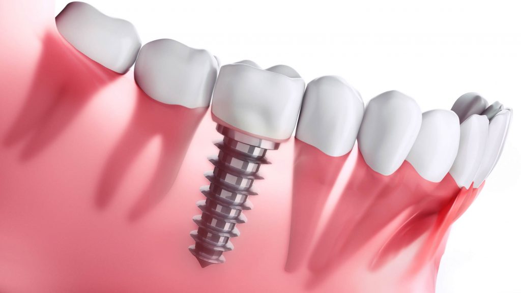 puentes dentales o implantes dentales