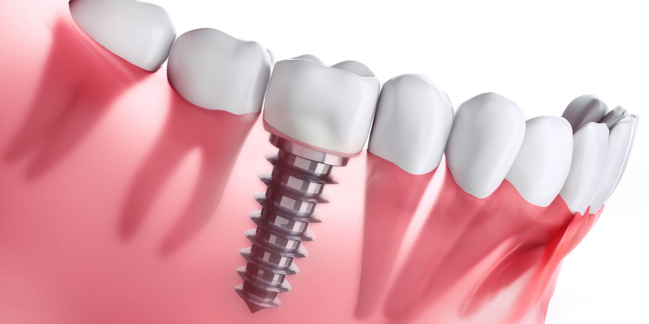 Implantes dentales Getxo - Belén Pérez