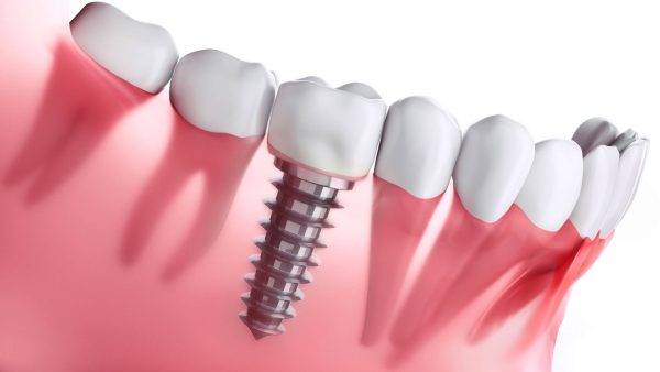 Implantes dentales Getxo - Belén Pérez