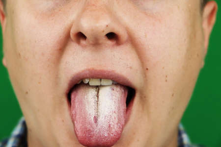 Hongos en la boca- Belén Pérez, dentista en Getxo