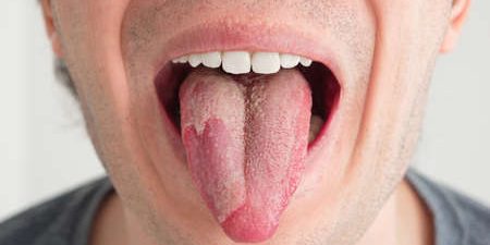 Hongos bucales - Belén Pérez, clínica dental en Getxo