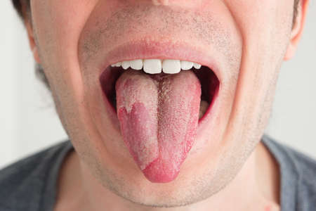 Hongos bucales - Belén Pérez, clínica dental en Getxo