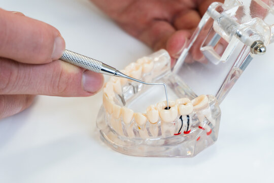 pulpitis reversible - Dentistas Getxo Belen Perez