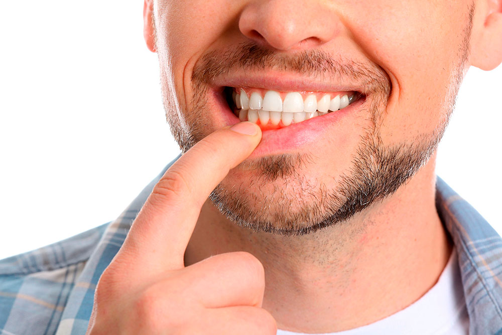 Pulpitis reversible - Belén Pérez clínica dental Getxo