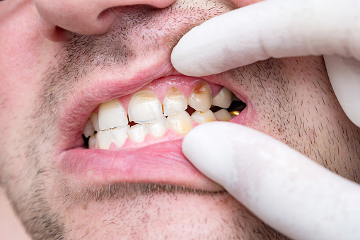 hipoplasia dental