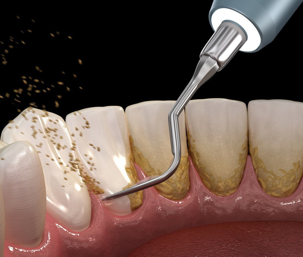 Limpieza de dentista del sarro del paciente