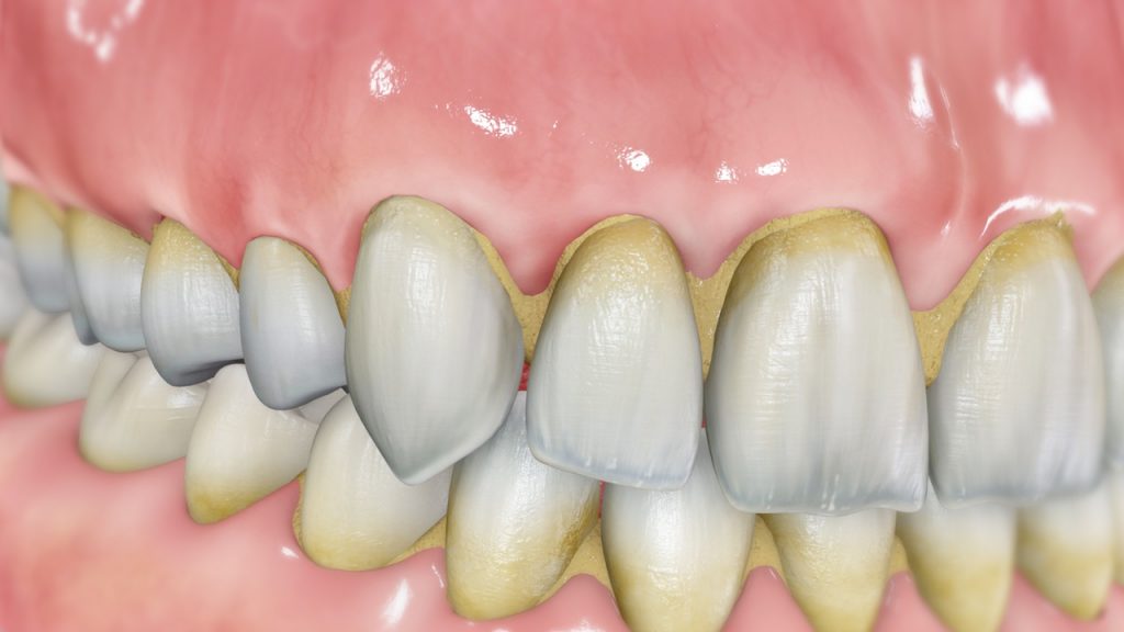 Dentadura con sarro acumulado