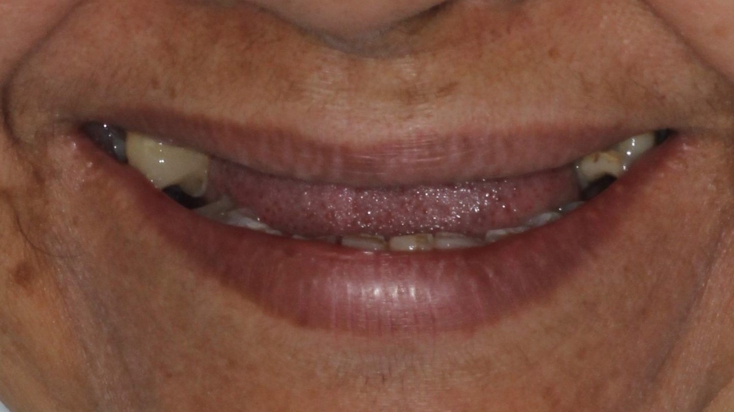 Antes rehabilitación implantes Antes Rehabilitación con implantes osteointegrados