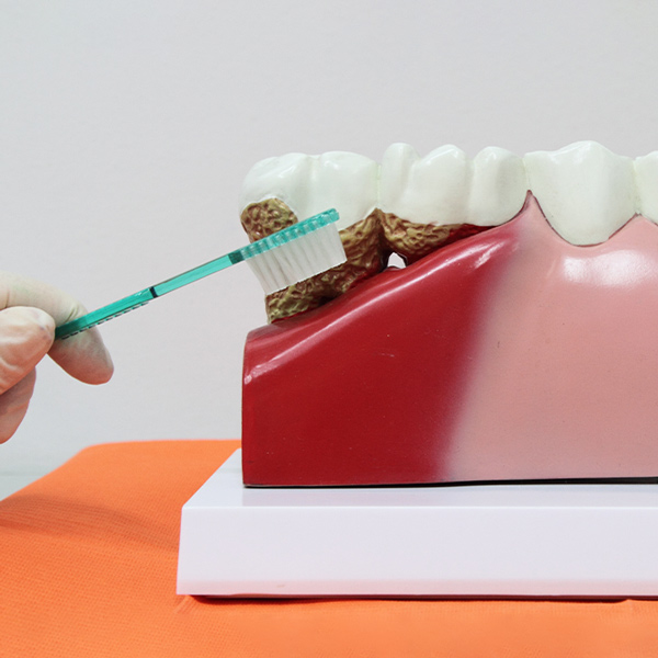 Tratamientos de periodoncia
