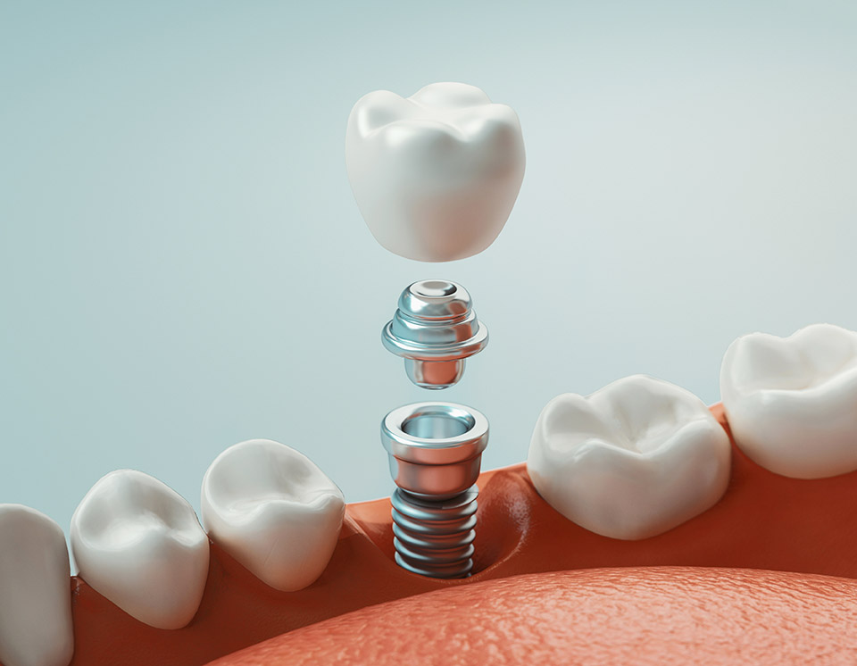Qué son los implantes dentales