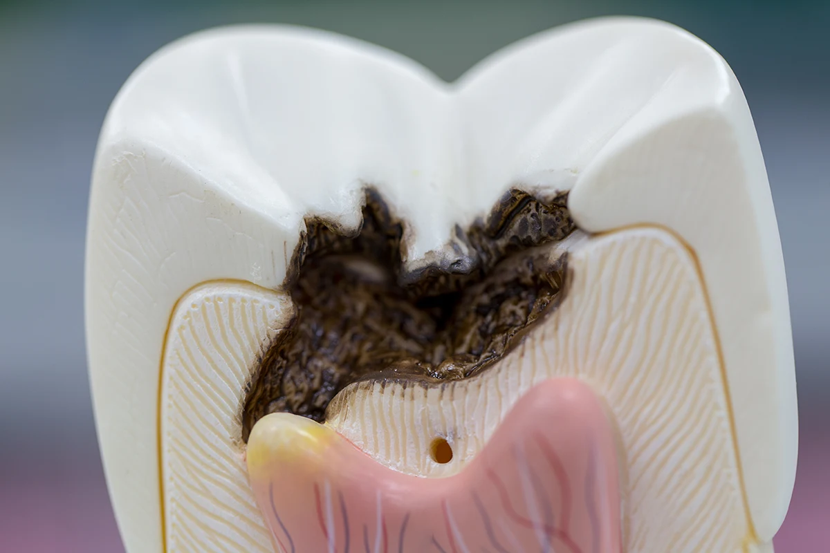 Síntomas endodoncia