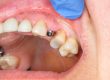 Cicatrización implantes dentales