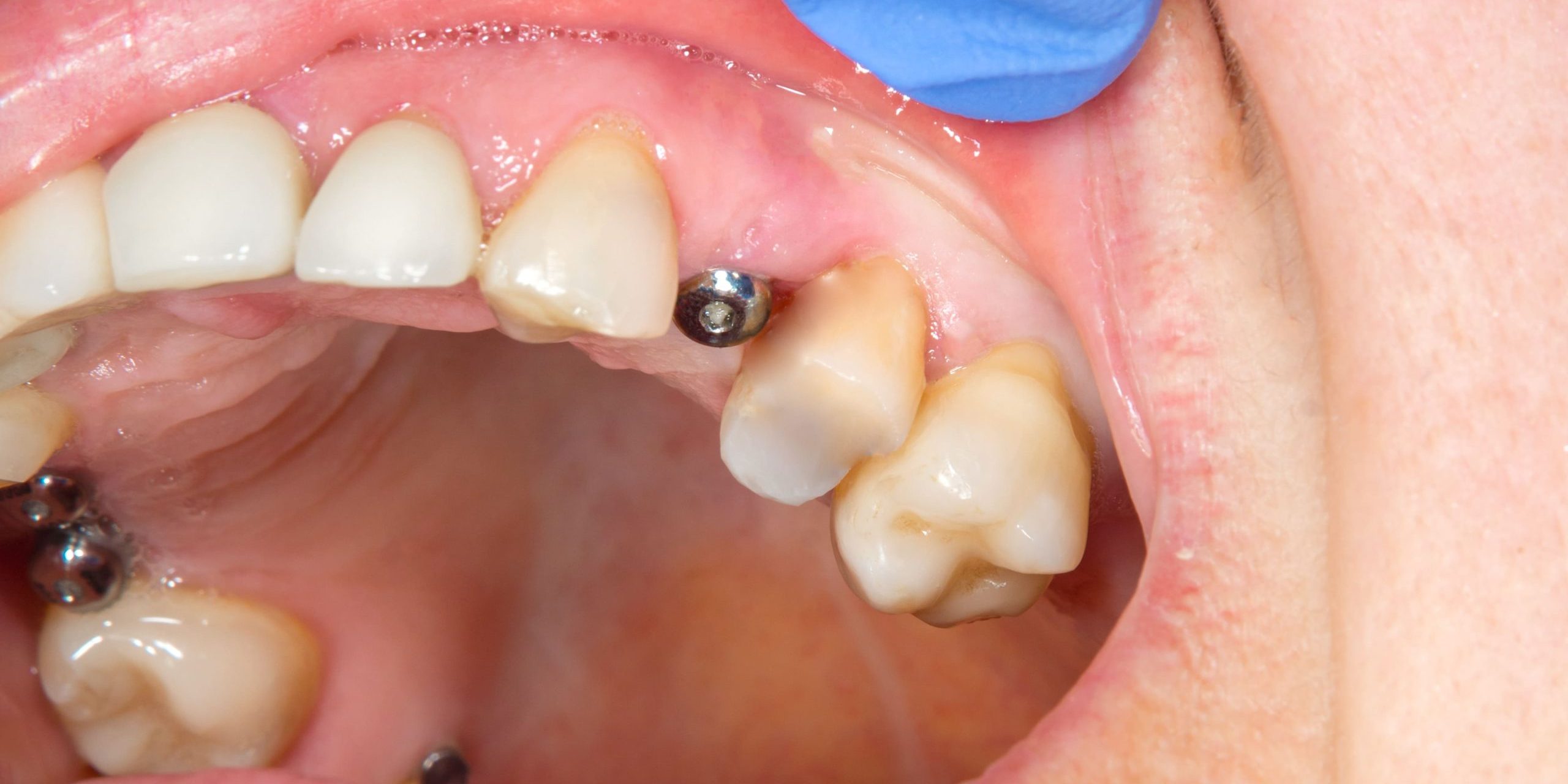 Cicatrización implantes dentales