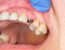 Cicatrización implantes dentales