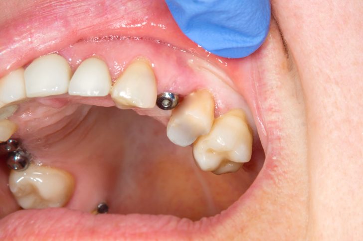 Cicatrización implantes dentales